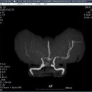 Rt. M1 occlusion, Lt. M1 severe stenosis, Rt proximal ICA stenosis 이미지