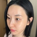 삼성동-40 | 삼성동피부과 40대 앞볼 스컬트라 후기