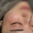 아이피부과 | 논현피부과 아이리쥬란 후기, 다크서클 고민 때문에 다녀온 내돈내산 솔직 후기