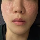 이수병원 | 이수역 피부과 리쥬란 후기 : SVIP병원, 효과, 통증