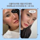 김천신경정신건강의원 | 오블리브의원 서울오리진 종로 쥬베룩스킨 아이리쥬란 일주일 후기