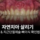 지웰DS치과의원 | 복대동 지웰시티치과, 임플란트 전 치근단절제술 가능한지 확인하세요