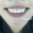 더,붙이다 | [내돈내산] 제로네이트 앞니6개 부착후기 | 드디어 붙이다..! | 신논현 티유치과