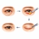미인만들기성형외과의원 | 신사성형외과 눈밑지방재배치? 하안검? 이 글로 종결합니다