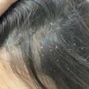 함께약국 | 니조랄 샴푸 지루성 두피염 약국템 후기 + 데일리 샴푸 추천