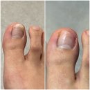 1387 | 부산 레푸스 부산하단점 문제성 발톱 무좀 관리 추천