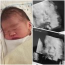 김태영내과의원 | 제왕절개 출산 1일차 : 강릉 세가온 산부인과 제왕절개 출산 후기