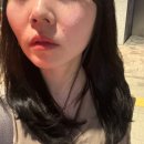 대구 동성로 피부과 온다리프팅 5만줄 비포 애프터