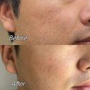 신생한의원 | 창원여드름흉터 한의원 율각테라피 후기 | 모공 및 색소침착 치료