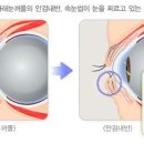 안검내반 / 안검외반 이미지