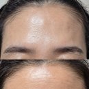 구자경피부과의원 | 이마 필러 보톡스 후기 : 잔주름 안녕, 인상은 부드럽게