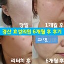 효성약국 | 경산 효성의원 6개월 후 솔직후기