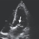 Whipple’s Disease with Endocarditis 이미지