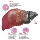 간염 간경변 줄기세포치료 이미지