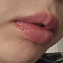 서산봄클리닉의원 | 입꼬리+입술필러 1회차 올클리닉 첫 방문에 찐만족 후기 통증 효과