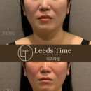 피부야 놀자 | 청라피부관리 리즈타임 윤곽리프팅관리 대만족 후기