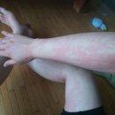 경희요한한의원 | 급성 두드러기 ㅡ 사진있음. 징그러울수있음.