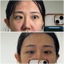 [남양주피부과/내돈내산] 모공치료 피코프락셀(2차) 효과 후기