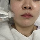 청담피부과 안아픈리쥬란 NP스킨부스터 물광/속광후기