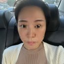 귀족 | 안면윤곽수술 후기 +팔자주름 귀족수술 후기 1탄 (내돈내산)