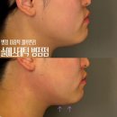 병점 피부관리 이중턱을 싹 잡아주자! 리프팅관리 솔에스테틱 병점점