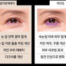 노블레스홍인식성형외과의원 | [W-9] 결혼전 효도성형 아빠 하안검 발품 후기