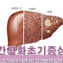 간경화 초기증상 치료 간 안좋을때 이미지