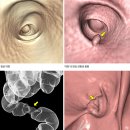전산화 단층촬영 대장조영술[computed tomography colonography] 이미지