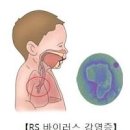 코감기 원인, 리노바이러스 및 (맑은 노란 콧물 재채기) 이미지