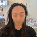 홍 헤어라인 | 대구 브라질홍 페이스왁싱 헤어라인 이마왁싱 전후비교