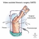 씨유 군포지샘병원점 | 남편 기흉수술 후기 - 군포지샘병원 수술비용, 통증 및 한달경과
