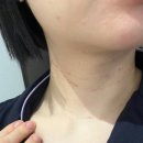 청담동 목주름필러 효과 멍 비포애프터 목주름차오름 시술 후기