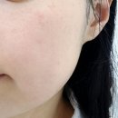 새움한의원 | 묵은각질 제거 효과갑 스킨스케일링 후기, 영통 피부관리샵 몰리 뷰티&amp;에스테틱