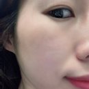 마곡웨딩관리 리즈베리뷰티 PHA물톡스 후기❤️