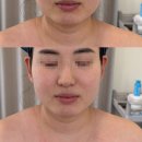 롬앤네일 - 울주군 보곡3길 40 | 옥련동 피부관리 송도 리프팅 전문 롬앤네일에서 받은 온다V핏 리프팅관리 (전후사진 확실한 후기)
