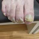 루덴네일 | 송파 잠실나루역 발톱무좀 문제성발 전문샵 후기 루덴풋케어