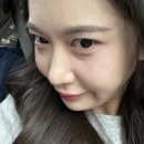 민* 외1인 | [내돈내산] 답답해서 상세히 올리는 ✨눈밑지방재배치✨ 리얼후기 #1(수술당일~2일차)