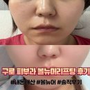 세안안전진단 | 구로피부과 볼뉴머 600샷 리프팅 내돈내산 솔직 후기! 효과 전후사진