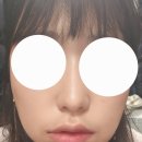 평생주치의 딱 좋은 치과의원 | 양쪽 매복 사랑니 발치 후기 feat. 평생주치의 딱 좋은 치과