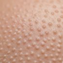 한독약국 | 모낭염? 여드름? 닥터예스 키놀젤 vs 약국 연고 (애크논, 에스로반) 솔직 비교 후기