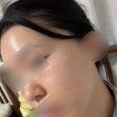 o-11 | 편평사마귀 성지 | 청량리자연튼튼의원 제거 후기 (내돈내산O, 4~11일차 후기)