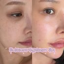 루비로 | 강남 논현역피부과 루비레이저 주근깨제거 내돈내산 후기!