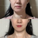 [평생학습관] 우울 및 스트레스 관리 | 부산 볼살지방흡입 + 심부볼제거 대만족해서 쓰는 후기(1) 수술당일~7일차