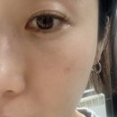 새오름피부과의원 | 서대문피부과 테라스의원 리핏레이저 흑자제거 찐 후기 1탄