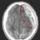 급성 경막하 출혈[ acute subdural hemorrhage ] 이미지
