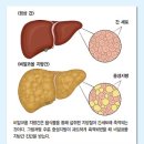 지방간의 진단과 관리 이미지