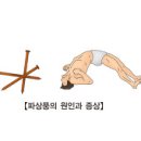 위험한 파상풍~!! 다들 잘 알고 계시지요?? ^^* 이미지