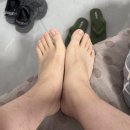무조미 레이저 써본 후기 (전역하고 발톱 개판 됐던 썰)