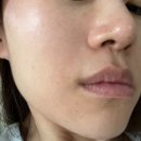청량리9 | 청량리피부과 소프웨이브 울쎄라 통증 후기