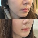 순자 | 신사역 피부과 순자리프팅 통증&amp;유지기간 리얼 후기